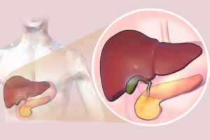 Colesterol alto é o vilão na maioria dos casos de pedra na vesícula